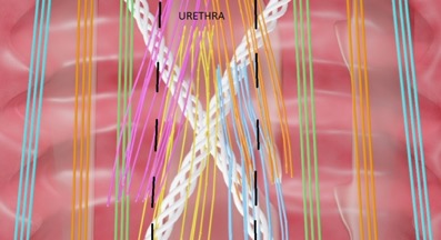 Vista Frontal de la Sub Urethral Spyder Web